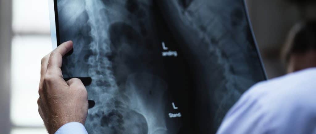 espondilolistesis Cirugía de espondilolistesis: ¿es indispensable?