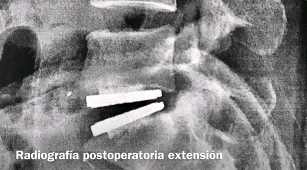 artoplastia portada Artroplastia lumbar o prótesis de disco