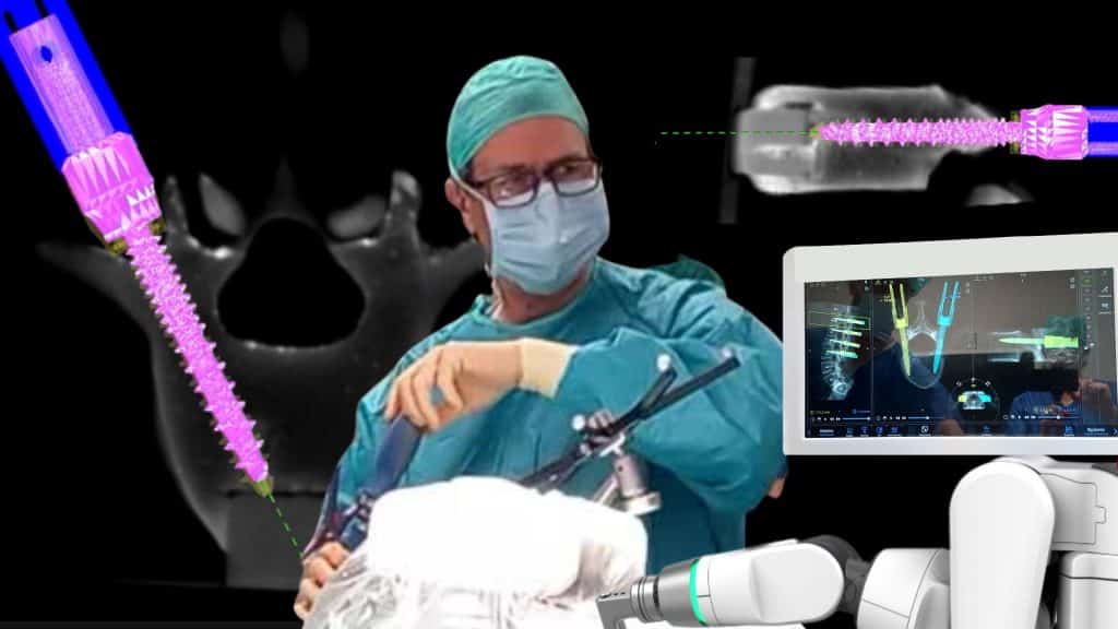 Cirugia Robotica de implantes de columna vertebral Navegación y cirugía robótica lumbar