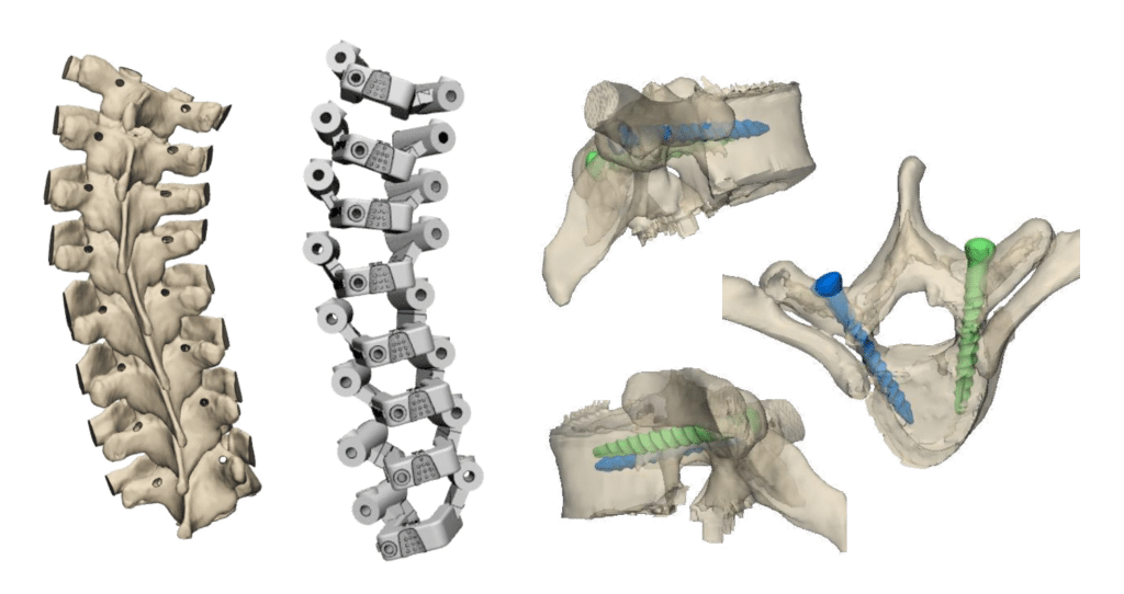 Guías 3D para la colocación de implantes vertebrales 1 guías 3d