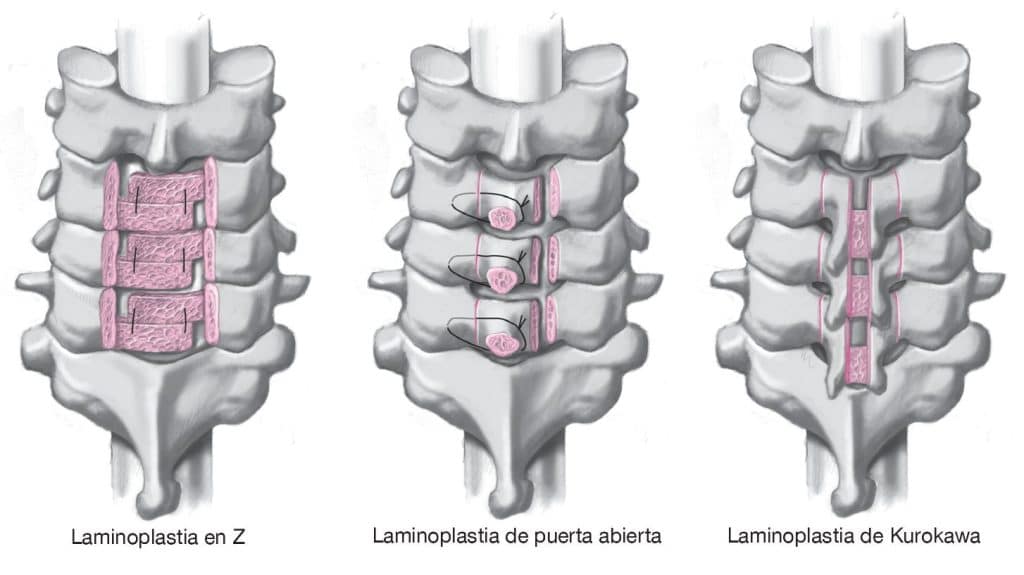 laminoplastias