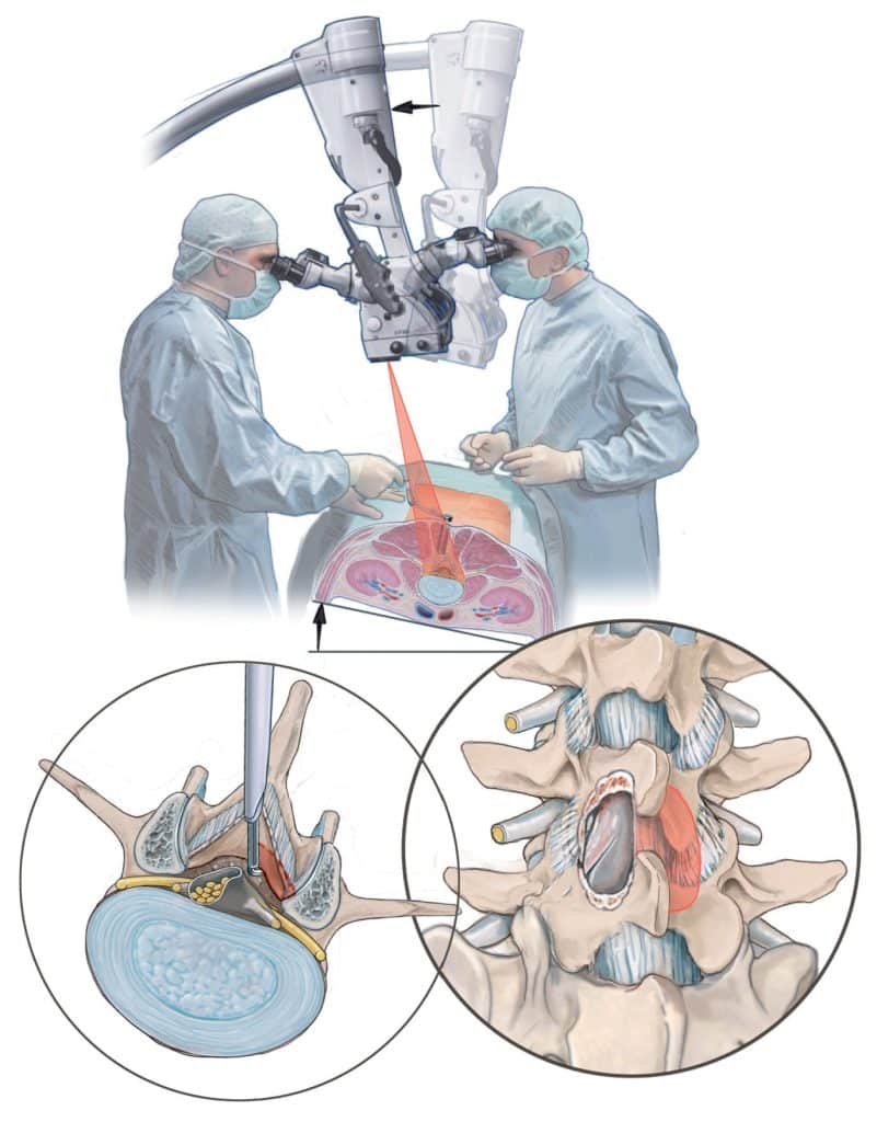 micro over the top La Descompresión Lumbar "Over-the-Top": Evolución, Técnica y Evidencia en la Era de la Cirugía Mínimamente Invasiva